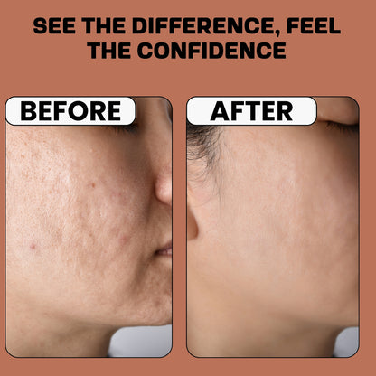 Salicylic acid and Rice water Facewash